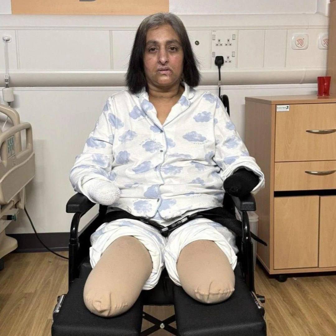 У Британії жінці ампутували кінцівки після зараження інфекцією через слину собаки